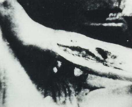 tropical ulcer on shin 1943